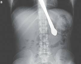USA: ”NON SONO BULIMICA” E INGOIA COLTELLO, LA FOTO