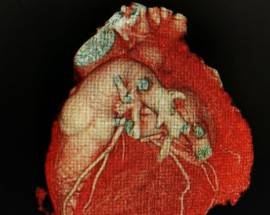 CORONAVIRUS:CARDIOLOGI, RISCHIO PIÙ MORTI INFARTO CHE COVID