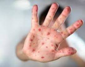 MORBILLO: 1.600 CASI E UN DECESSO NEI PRIMI 9 MESI DELL’ANNO