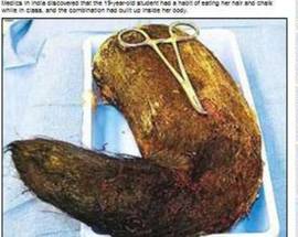 INDIA: MANGIA CAPELLI E GESSO, ASPORTATA MASSA DI 2 CHILI DALL’INTESTINO