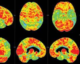 DIAGNOSI PRECOCE DELL’ALZHEIMER: A CHIETI ESEGUITA PRIMA PER CEREBRALE