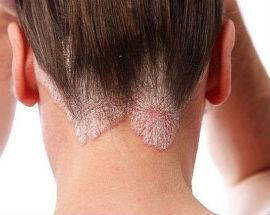 PSORIASI: IL 29 OTTOBRE VISITE GRATUITE DI PREVENZIONE ALL’OSPEDALE DELL’AQUILA