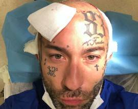 TRAPIANTO DI CAPELLI PER SIMONE COCCIA COLAIUTA: ”FATE CIO’ CHE VI RENDE FELICI”