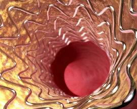 CALCIATORE COLPITO DA INFARTO SALVO GRAZIE A TRE STENT