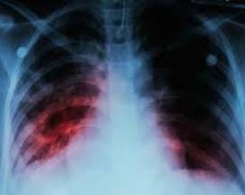 TUBERCOLOSI, NASCE CONSORZIO PER STUDIO NUOVI FARMACI