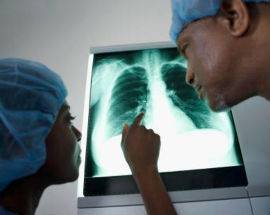 TUMORE DEL POLMONE: GIUNTA REGIONALE APPROVA PERCORSO TERAPEUTICO