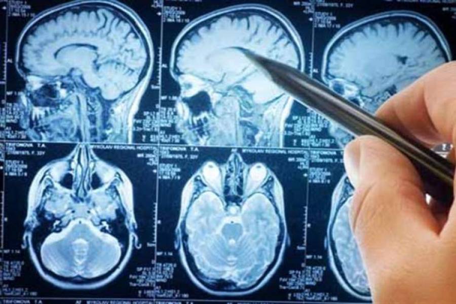 SCLEROSI MULTIPLA, OGNI TRE ORE UNA DIAGNOSI: 3.600 CASI L’ANNO