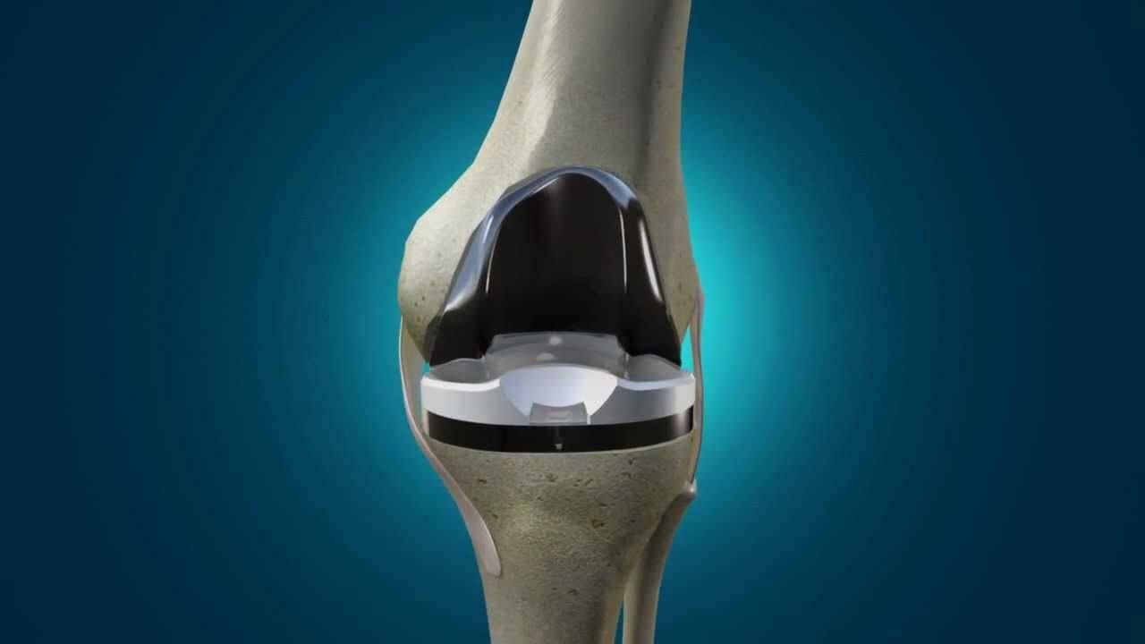 INI CANISTRO: NUOVA TECNOLOGIA PER PROTESI GINOCCHIO, VALENTE, “CON EXACTECH INTERVENTI PERFETTI”