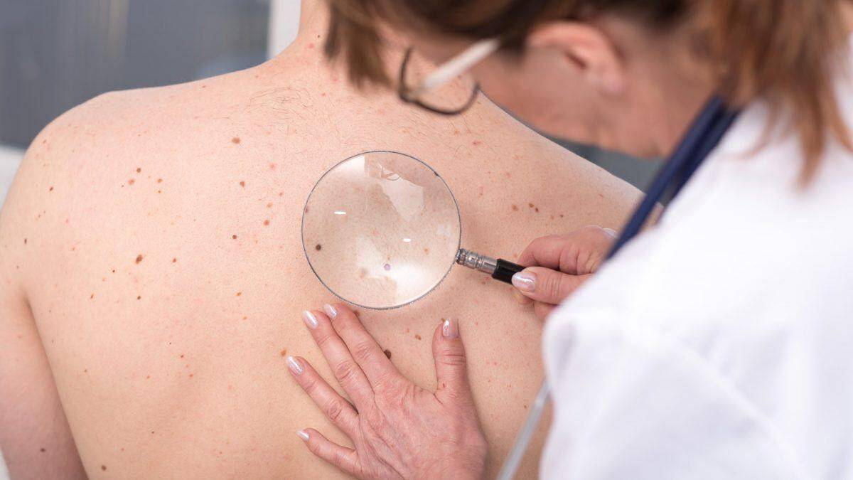 “PER MELANOMI PREVENZIONE ESSENZIALE”, FARGNOLI: “TORNATE A FARVI VISITARE”