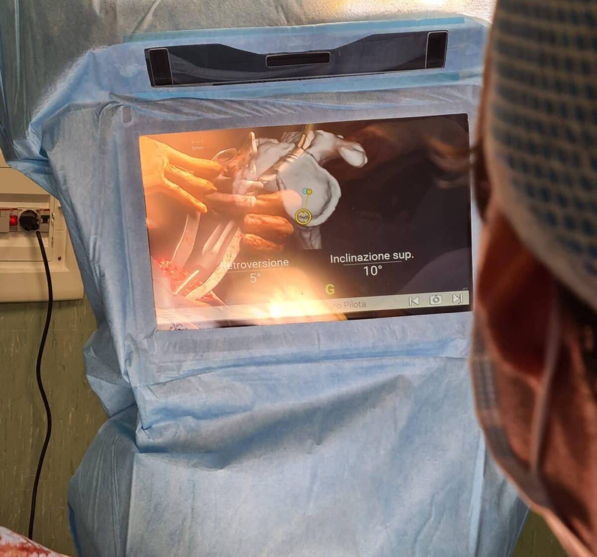 ASL TERAMO, INNOVATIVO INTERVENTO PER PROTESI DI SPALLA CON ASSISTENZA COMPUTERIZZATA A ATRI
