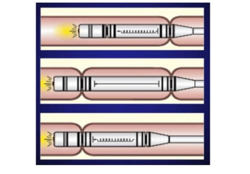 COLONSCOPIA ROBOTICA: A POPOLI INNOVAZIONE CHIRURGIA ENDOSCOPICA