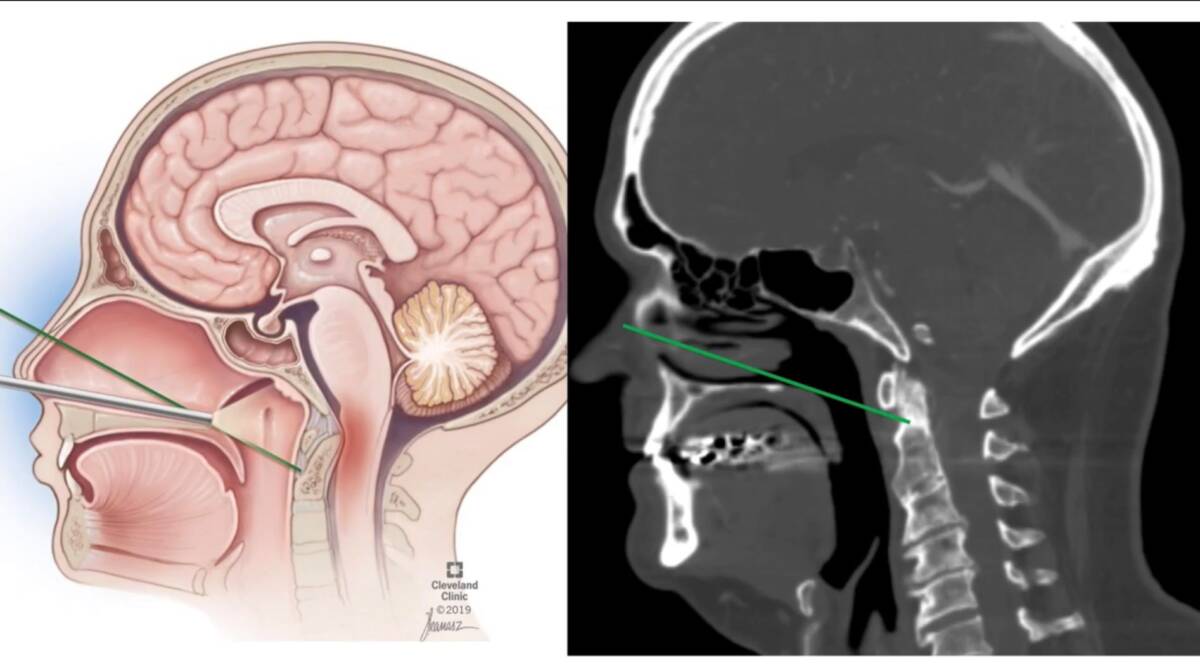 L’AQUILA: INTERVENTO INNOVATIVO ENDOSCOPICO PER RIMUOVERE UNA VERTEBRA TRA CRANIO E CERVICALE
