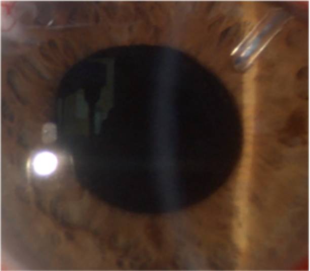 GUERRA AL GLAUCOMA: ESEGUITO PER LA PRIMA VOLTA IN ABRUZZO UN INTERVENTO  DI ULTIMA GENERAZIONE
