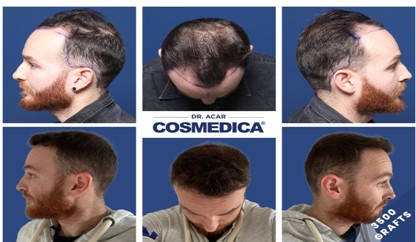 TRAPIANTO CAPELLI PRIMA E DOPO: COME CAMBIA TUTTO